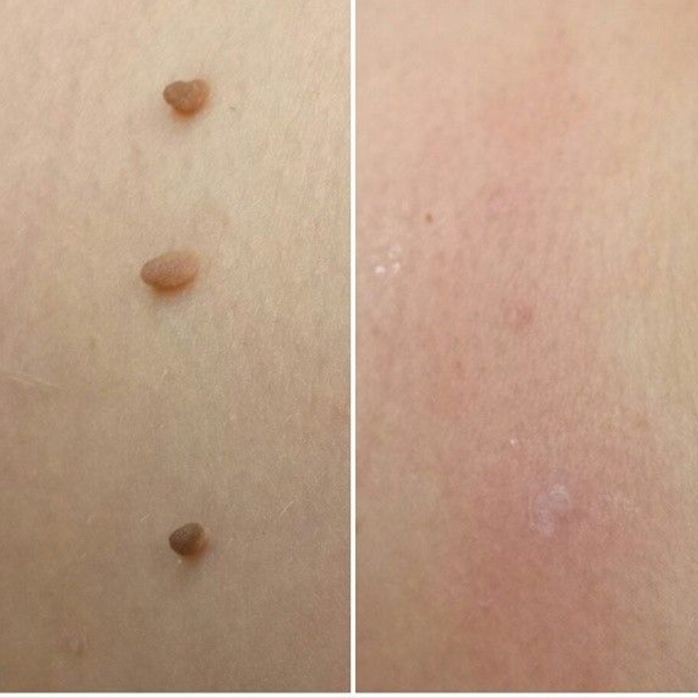 Levia™ — Addio fibromi cutanei