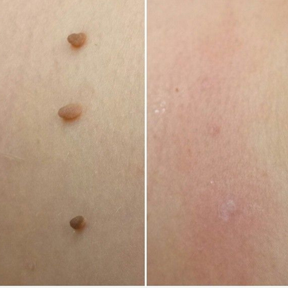 Levia™ — Addio fibromi cutanei