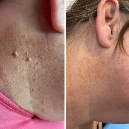 Levia™ — Addio fibromi cutanei