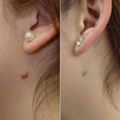 Levia™ — Addio fibromi cutanei