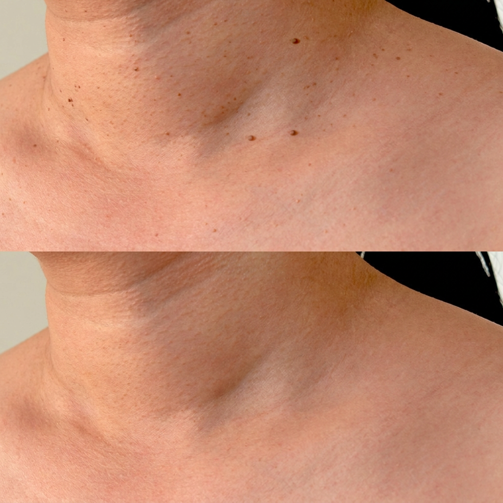 Levia™ — Addio fibromi cutanei