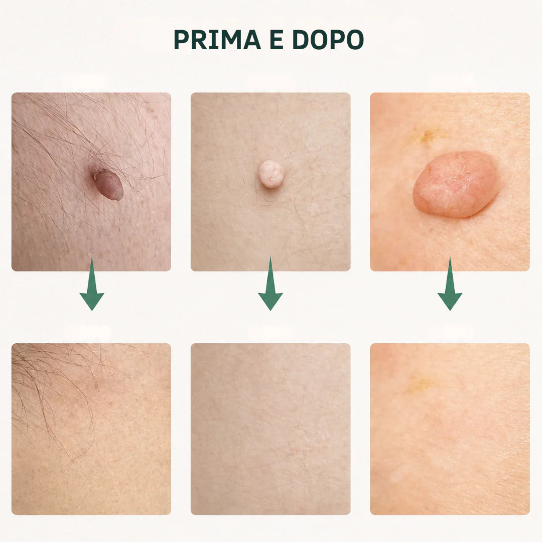 Levia™ — Addio fibromi cutanei