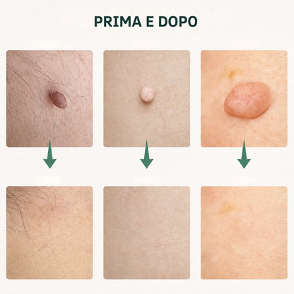 Levia™ — Addio fibromi cutanei